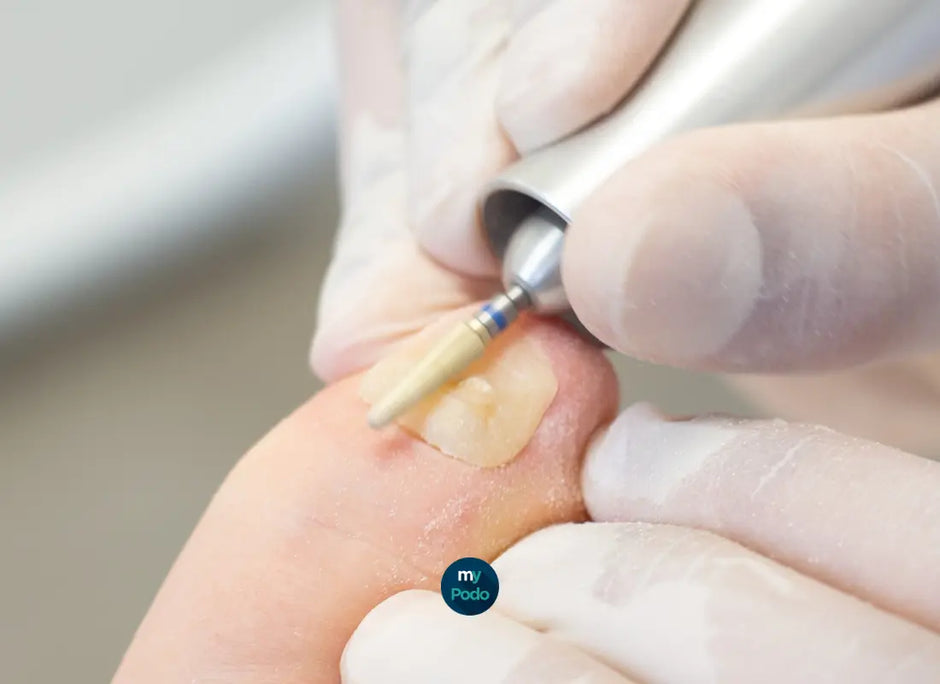 Guide bagues fraises à ongles My Podologie